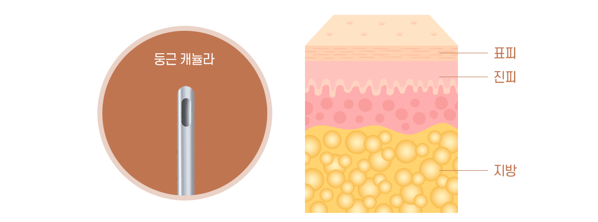 손등 지방이식이란?