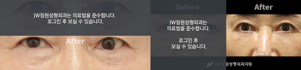 절개부위 - 로그인 후 보실 수 있습니다.