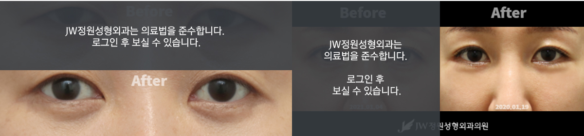 애교근육 보존