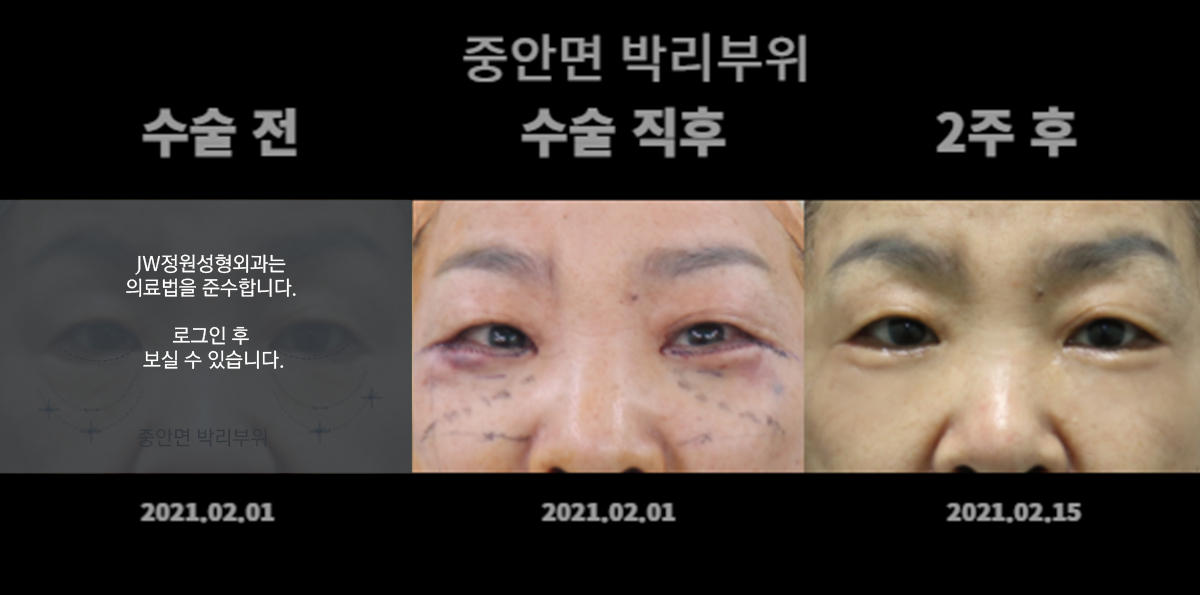 박리부위 - 로그인 후 보실 수 있습니다.