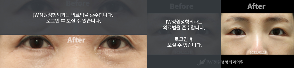눈물고랑재배치 - 로그인 후 보실 수 있습니다.