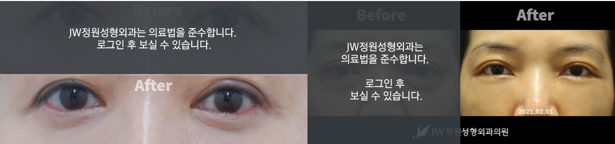 외측지방이식 - 로그인 후 보실 수 있습니다.