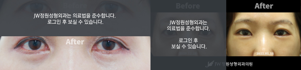 피부절제 - 로그인 후 보실 수 있습니다.