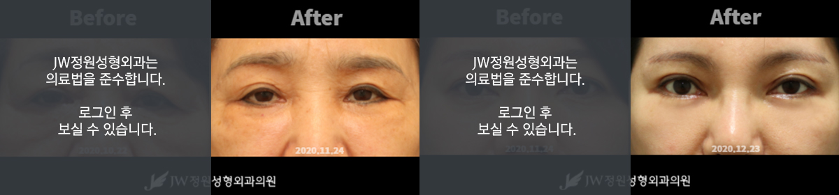 피부절제 - 로그인 후 보실 수 있습니다.