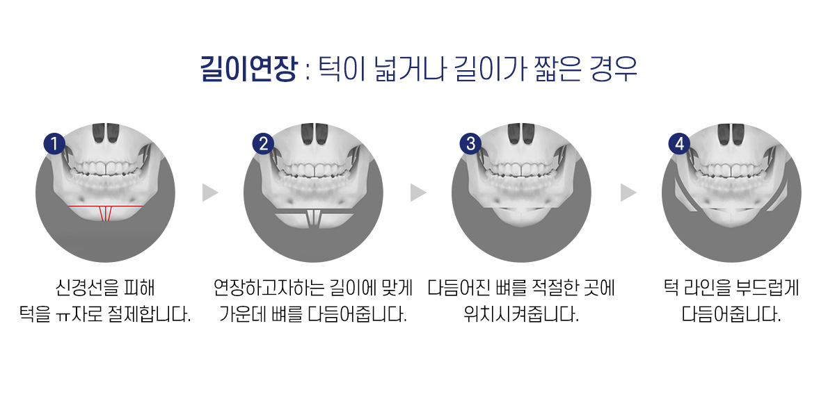 길이연장