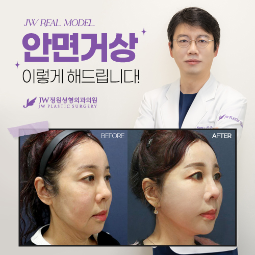 안면거상 리얼모델 모집