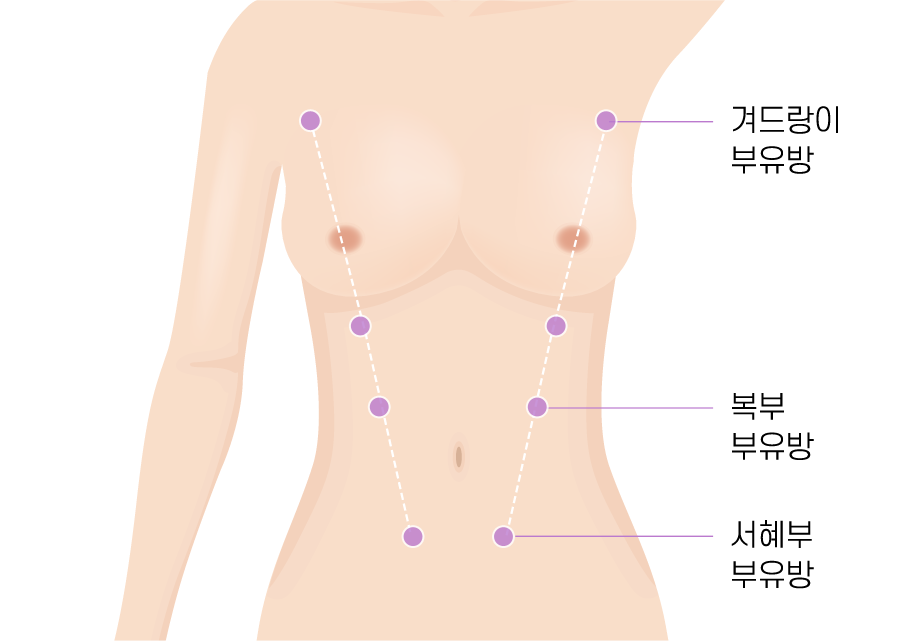 부유방 원인