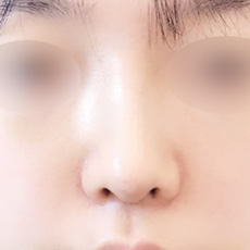 콧대+코끝 연장술