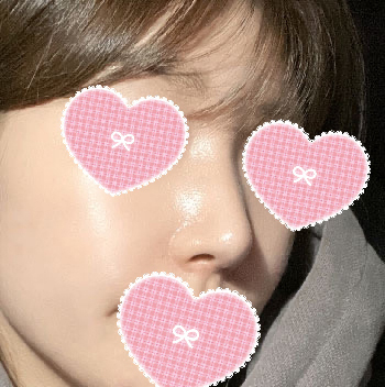 매부리교정, 코끝(귀연골), 비공내리기