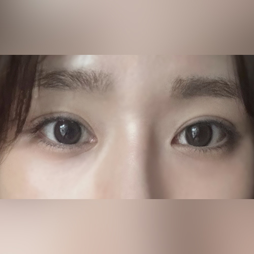 눈재수술, 매몰