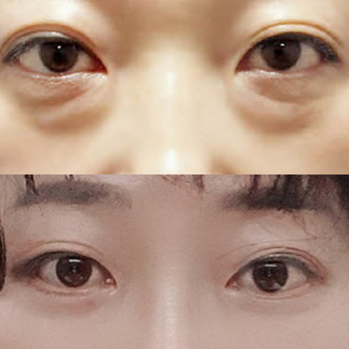 하안검 중안면거상