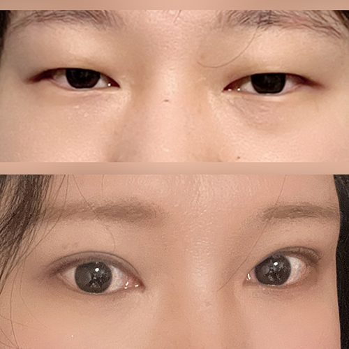 절개 눈매교정