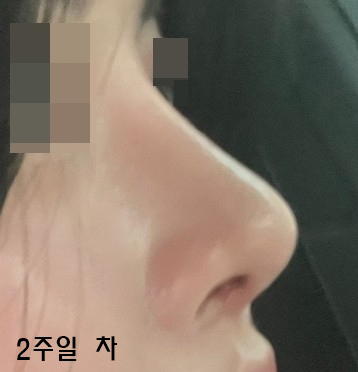 콧대(실리콘), 코끝(역회전이식,귀연골), 비공내리기