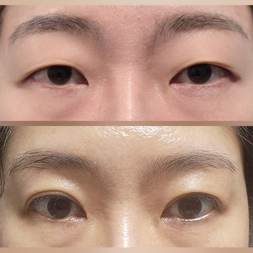 상안검