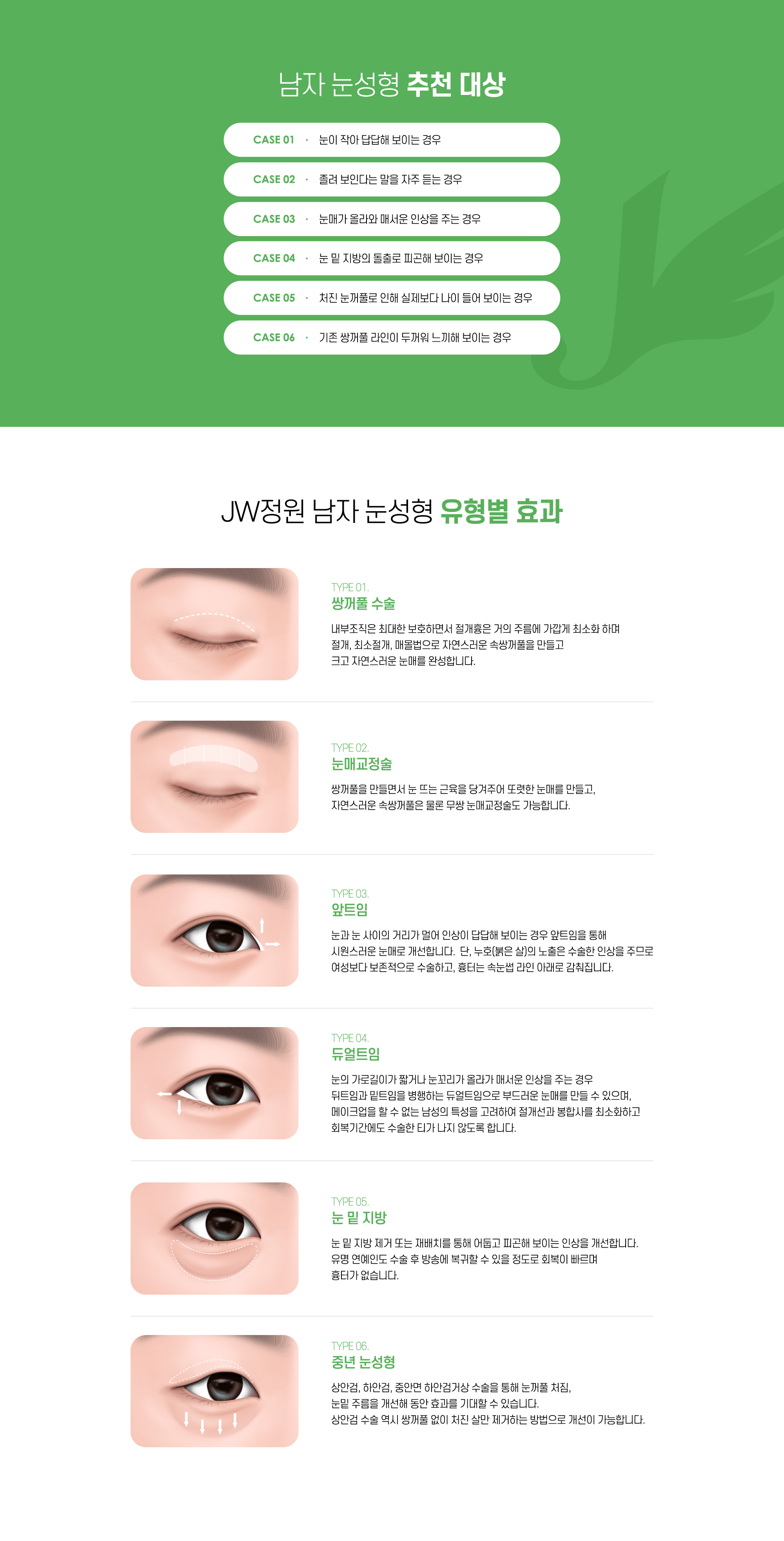 정원성형외과 남자 눈성형
