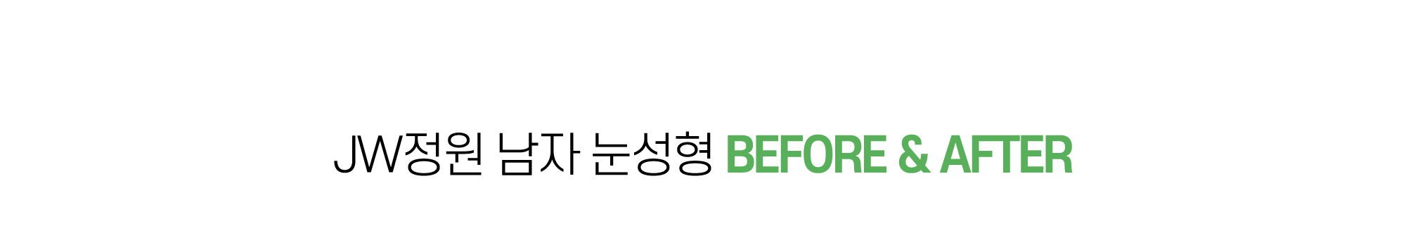 정원성형외과 남자 눈성형